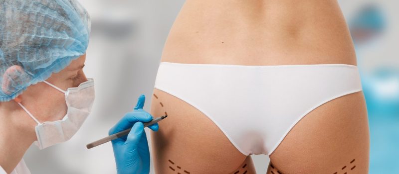 aumento de gluteos con acido hialuronico malaga