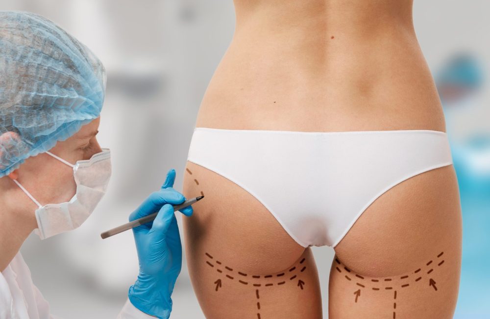 aumento de gluteos con acido hialuronico malaga